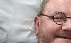 smiling man receiving acupuncture treatment on his earlobes